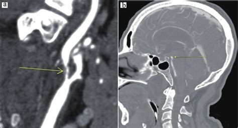 A Initial Ct Angiogram Showing 99 Stenosis Of Right Internal Carotid