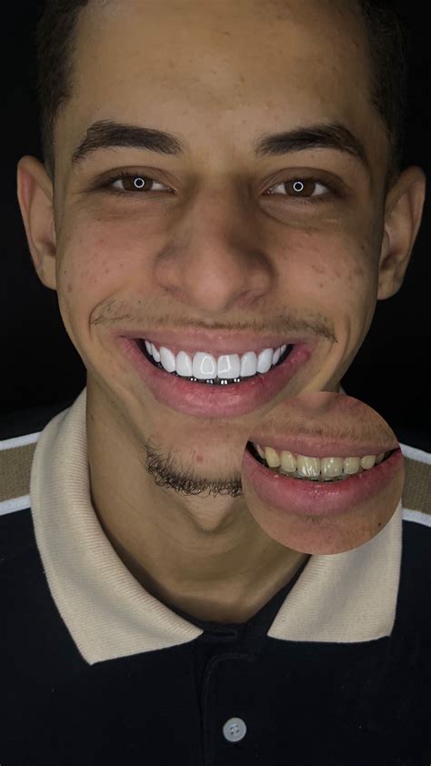 FACETAS EM RESINA | Transformação em FACETAS DE RESINA PREMIUM | Instagram
