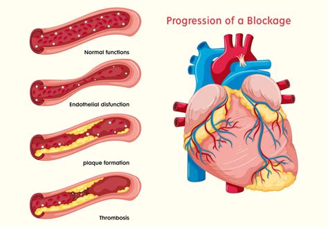 7 Heart Blockage Symptoms At Early Stage Know Before Its Too Late In