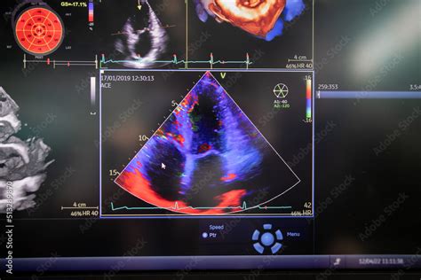 Ultrasound of the heart, Echocardiography (ultrasound) machine Stock ...