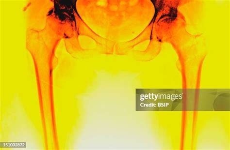 Degenerative Knee Photos And Premium High Res Pictures Getty Images