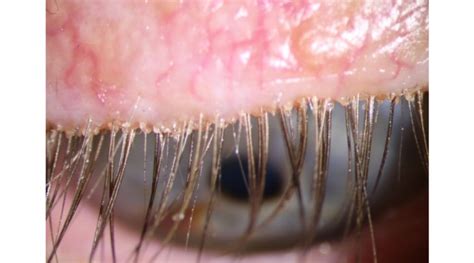 Lotilaner Shows Promise For Treating Demodex Blepharitis Obn