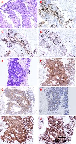 Full Article Next Generation Sequencing Of Synchronous Multiple