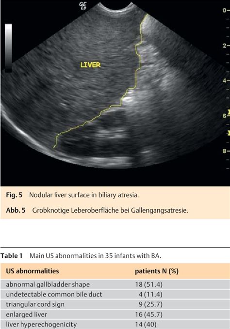 Figure 3 From Ultrasound Scanning In Infants With Biliary Atresia The