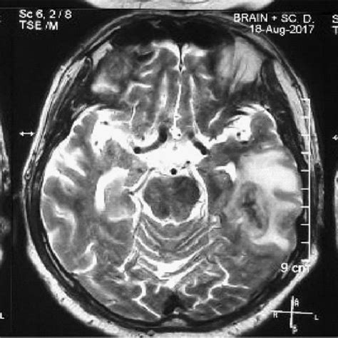 mri  weeks persistent lesion  left temporal lobe  appearance