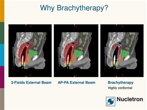 Ppt Introduction To Brachytherapy Powerpoint Presentation Free