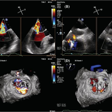 Mitral Valve Quantification Showed Dilated Mitral Valve Annulus