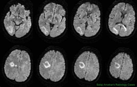 Dr Balaji Anvekar Frcr Tumefactive Demyelination Mri