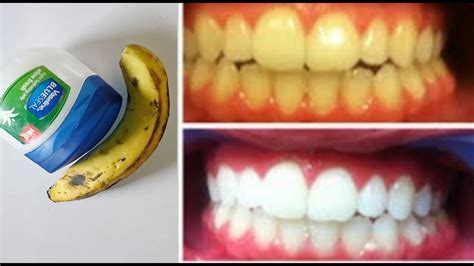 No Sticky Turn Yellow Teeth To Pearl White And Shine How To Whiten Your Teeth Naturally Youtube