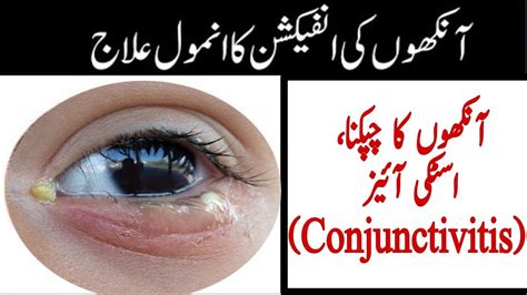 Eye Infection Home Remedies Eye Infection Treatment Youtube