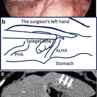 Case Presentation A Intraoperative Endoscopic Photograph Of The