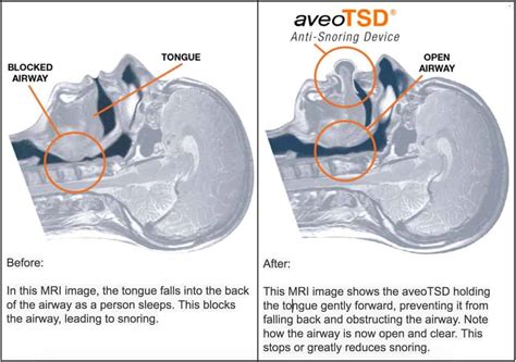 Snoring and Apnea Treatment: Exploring Aveo Tongue Stabilizing Devices ...