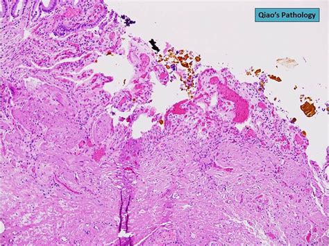 Flickriver Photoset Angiodysplasia Of The Gallbladder By Qiao S