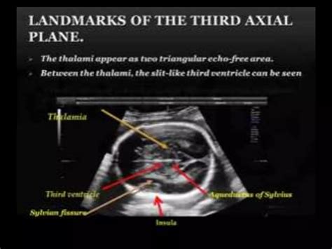 2 Fetal Echo Part 2 Dr Ahmed Esawy Ppt