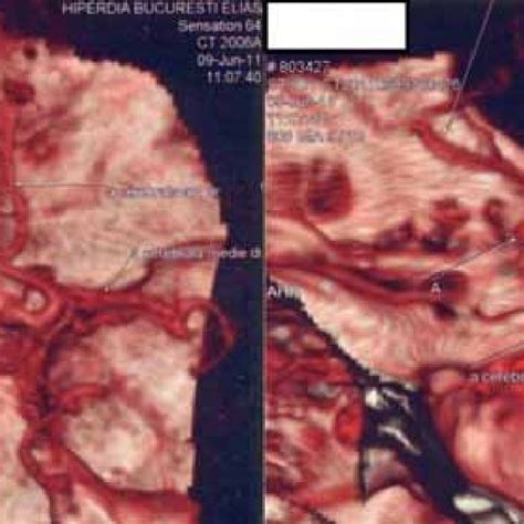 Angioct Anterior Communicating Artery Aneurysm Download Scientific