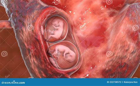 Monozygotic Twins In Uterus With Single Placenta D Illustration