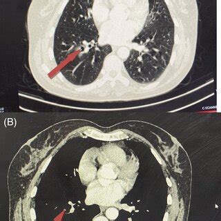 Chest CT scan: Lung parenchyma window (A) and mediastinal window (B)... | Download Scientific ...