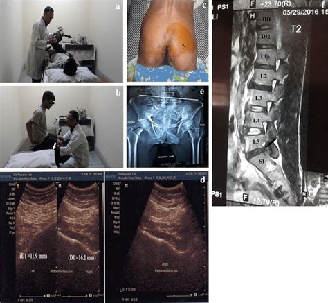 Different Clinical Presentations Of Piriformis Syndrome A Fair