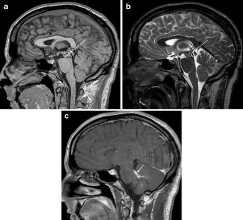 Tectal glioma causing hydrocephalus in a 14-year-old boy. a Sagittal... | Download Scientific ...