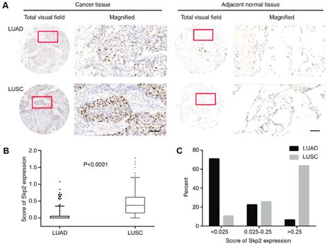 Skp Expression In Lung Cancers A Immunohistochemical Staining Of