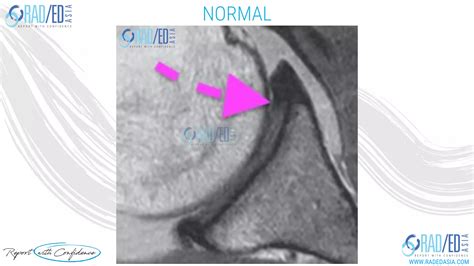 Mri Shoulder Labrum How To Differentiate Cartilage Undercutting From A