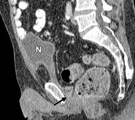 Follow The Stream Imaging Of Urinary Diversions RadioGraphics