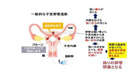 両側卵管閉鎖の診断後、すぐのftは必要か？ よくあるご質問 徐クリニック