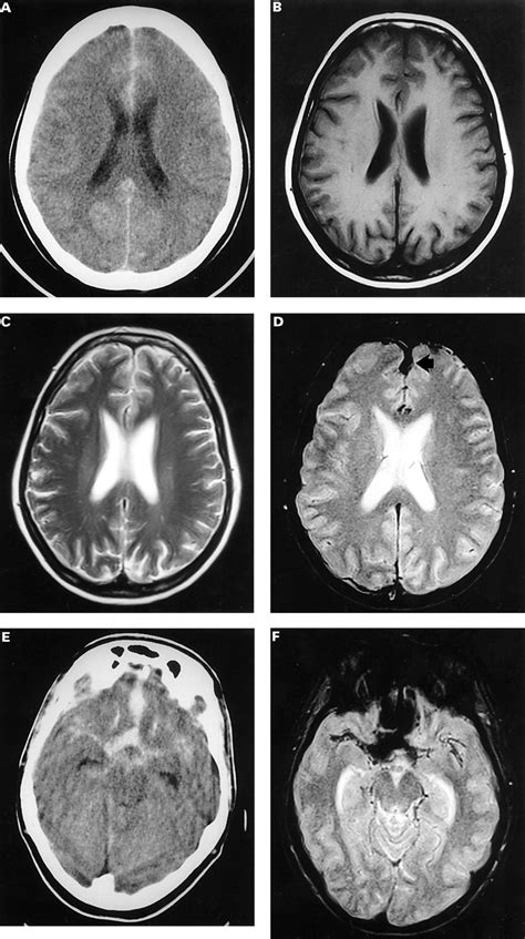 Subarachnoid Space Hemorrhage Ultrasound