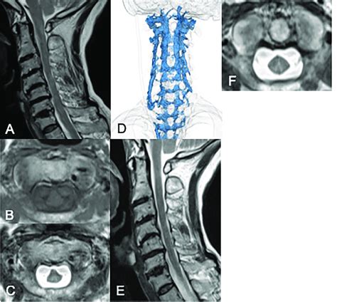 Case Sagittal T Weighted A And Axial T T Weigthed B And C