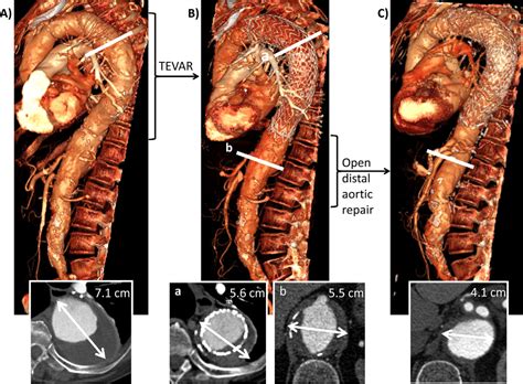 Figure From From The Society For Clinical Vascular Surgery Staged