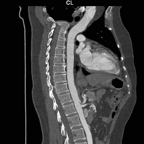 Ultra Low Dose Ct Scan Melbourne Radiology