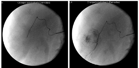 Hepatic Arteriogram Showing The Vascularization Of The Two Lesions