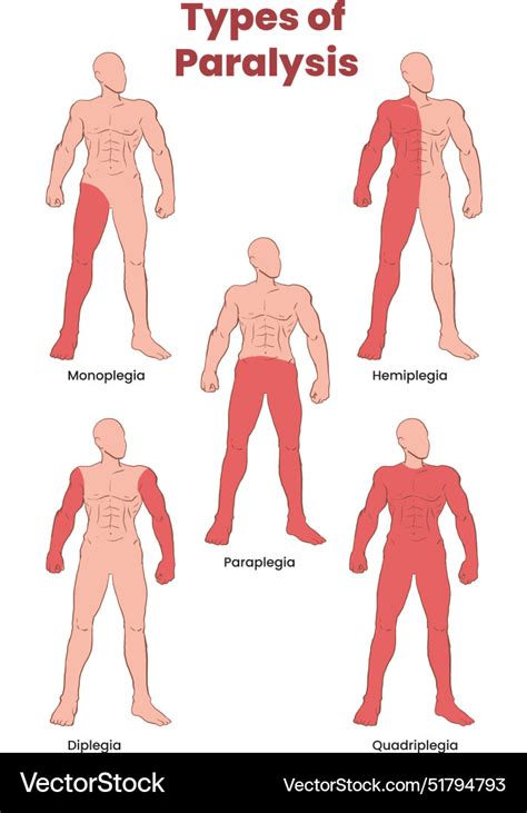 Types of paralysis Royalty Free Vector Image - VectorStock