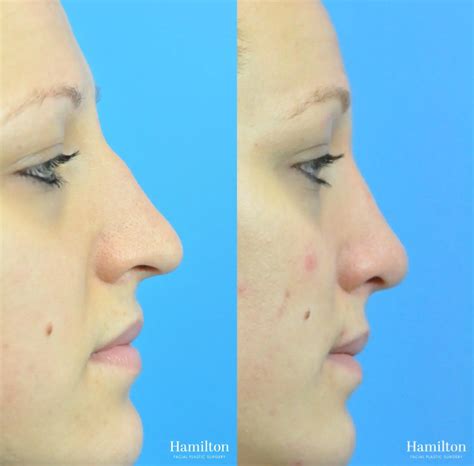 Rhinoplasty Before And After Gallery Patient 49