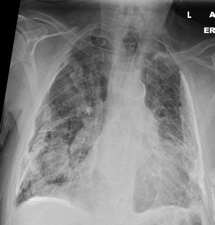 Ivory White Calcified Pleural Plaques