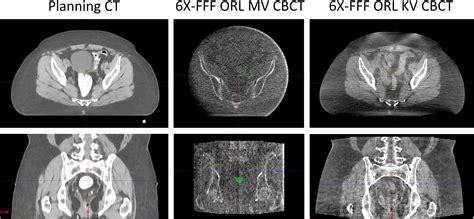 Initial Clinical Experience Treating Patients With Gynecologic Cancers