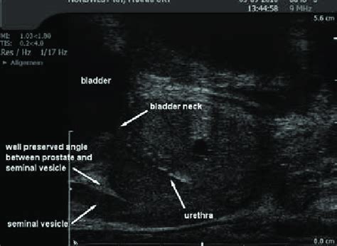 Prostate Ultrasound Anatomy