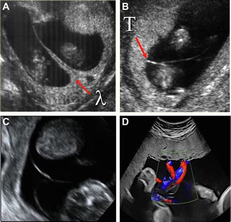 Guideline No 440 Management Of Monochorionic Twin Pregnancies