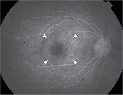 Acute And Painless Monocular Vision Loss In A Human Immunodeficiency