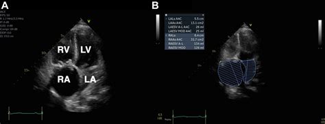 Pulmonary Vein Systolic Flow Reversal Seen With Severe Tricuspid