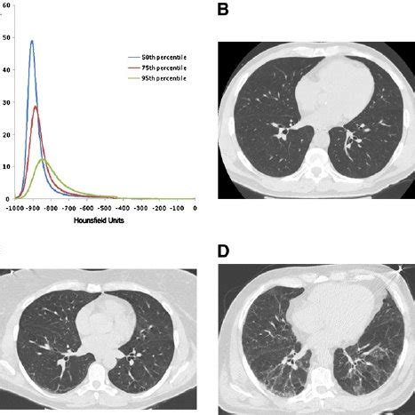 A Histograms Of Lung Attenuation And B D Representative