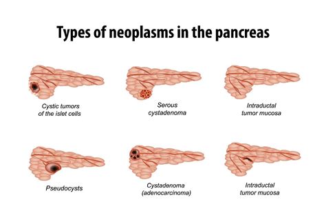 Pancreatic Cyst Treatment Singapore - Lee Surgery | CT Scan