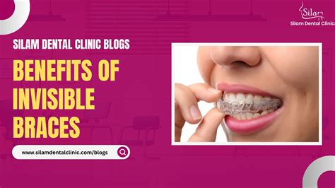 Benefits Of Invisible Braces Silam Dental Clinic