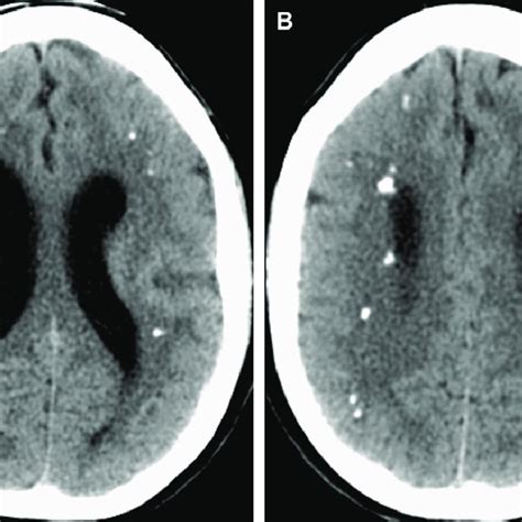 Pdf Pediatric Intracranial Infections