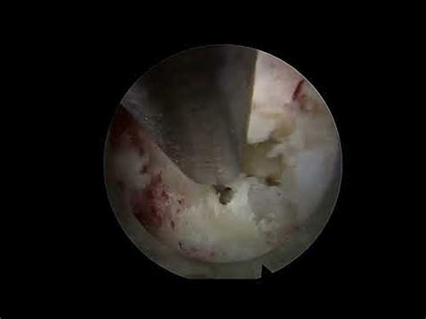 Endoscopic Lumber Discectomy YouTube