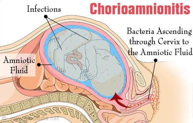 Intra Amniotic Infection Chorioamnionitis Causes Symptoms