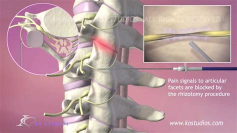 Cervical Facet Syndrome And Rhizotomy Youtube