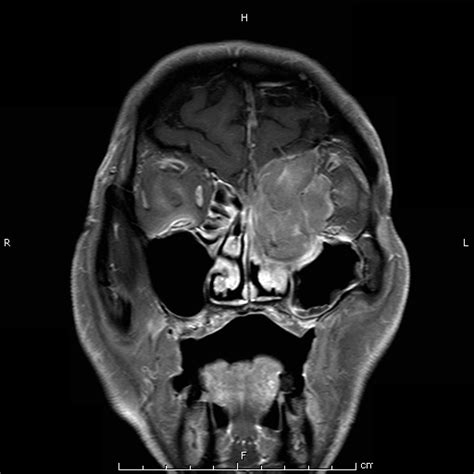 Ethmoid Sinus Malignancy