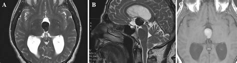 Preoperative Mri A Axial T2 Weighted Image B Sagittal T2 Weighted Download Scientific