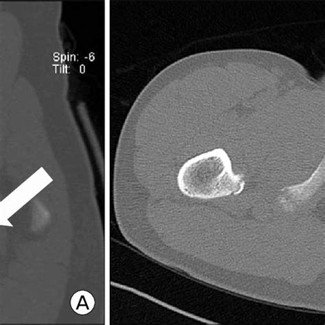 Pelvis Outlet Radiograph Showing Avulsion Fracture Of Ischial